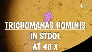 Trichomonas Hominis in stool microscopy at 40X [upl. by Natiha]