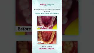 Rejove32 Aligners Vs Lower Incisor Extraction [upl. by Atekihs]