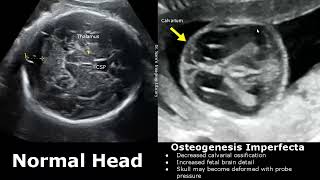 Fetal Musculoskeletal Ultrasound Normal Vs Abnormal Image Appearances  Skeletal Dysplasias MSK USG [upl. by Prosser]