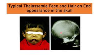 Beta Thalassemia and Alpha Thalassemia  Types Diagnosis and Treatment  Thalassemia Major amp Minor [upl. by Corbett]