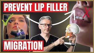 Prevent Lip Filler Migration  Causes Prevention and How to Treat [upl. by Georg]