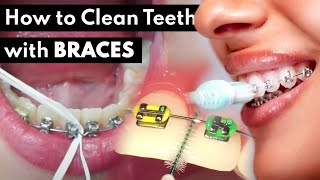 How to Clean the Teeth with Braces [upl. by Anidem]