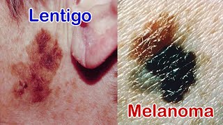 Old Age Spots Lentigo  Malignant Melanoma Part 1 amp 2 One Is Common and One Is Deadly [upl. by Kra]