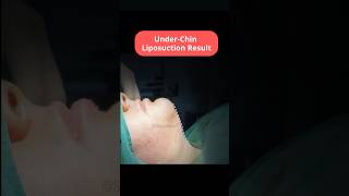 Under Chin Liposuction  Under Chin Fat Removal  Chin Liposuction Before After SB Aesthetics [upl. by Ilahtan]