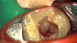 Periodontitis Apical Purulenta de 36 [upl. by Anihc845]