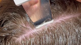 Scalp Treatment for DandruffBuildup [upl. by Delahk]