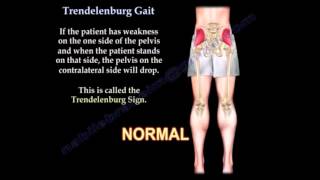 Trendelenburg Gait Everything You Need To Know Dr Nabil Ebraheim [upl. by Sibilla]