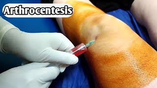 شاهد كيف يتم سحب سوائل الركبة  Knee fluid removal  Arthrocentesis  Synovial fluid aspiratio [upl. by Millhon744]