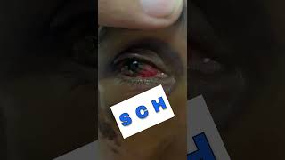 Subconjunctival Hemorrhage Part 4 Shorts SubconjunctivalHemorrhage [upl. by Hummel950]