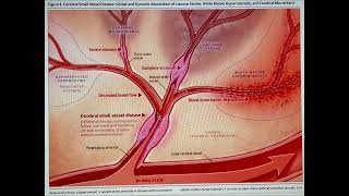 CADASIL  Brain Pathophysiology [upl. by Gnouhk856]