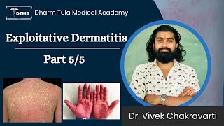 Dermatitis  Exfoliative Dermatitis Hindi  Types  Part 55 Eczema  Skin Disease  Skin Infection [upl. by Lorraine]