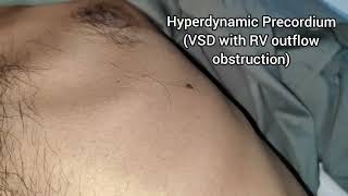 Hyperdynamic Precordium Video [upl. by Adli]