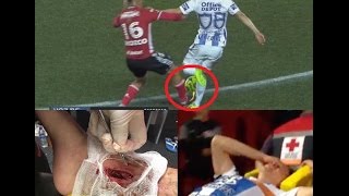 Terrible Lesión del CHUCKY Lozano  Horrible Injury [upl. by Sydel]