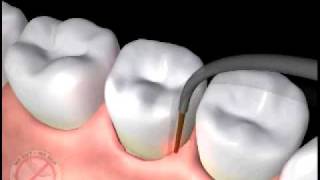 Animation of Laser Periodontal Therapy [upl. by Strephonn481]