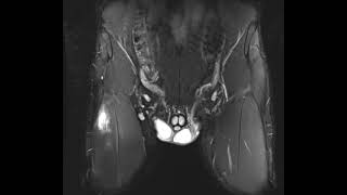 Athlete with rectus femoris tear [upl. by Vitalis]