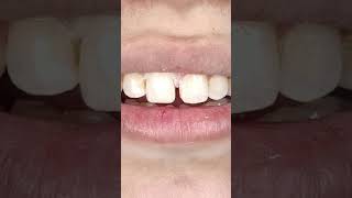 Pfm Crown Vs Zirconia Crown  Dr Waqas Ch Dental Clinic [upl. by Gough]