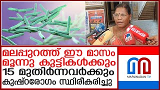 മൂന്നു കുട്ടികള്‍ക്കും15 മുതിര്‍ന്നവര്‍ക്കും കുഷ്ഠരോഗം സ്ഥിരീകരിച്ചു I Leprosy [upl. by Labana965]