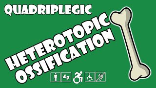 Heterotopic Ossification HO Explained  Quadriplegic C5C6C7 [upl. by Thackeray]