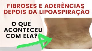 Tratamento para Fibroses e Aderências depois da lipoaspiração entenda o que aconteceu com ela [upl. by Roderich]