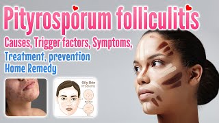 Pityrosporum folliculitis definition causes symptoms diagnosis treatment preventionhome remedy [upl. by Holzman233]