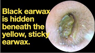 Black earwax is hidden beneath the yellow sticky earwaxear wax removal  ear cleaning  ASMR [upl. by Flip]