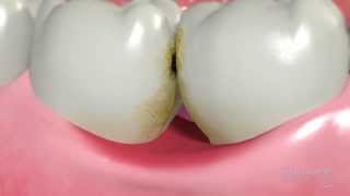 Tooth extraction and SOCKET PRESERVATION  How is it done [upl. by Koloski]