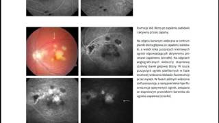 Angiografia fluoresceinowa i indocyjaninowa  Maciej Gawęcki [upl. by Cerf121]