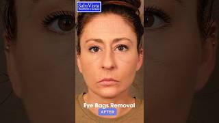 This is how we do eyelids or eyebags removal surgery eyebagsurgery bestplasticsurgeon turkey [upl. by Dwyer]