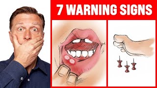 The 7 WARNING Signs of a B12 Deficiency  Dr Berg [upl. by Florio]