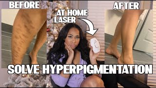 HOW TO FIX HYPERPIGMENTATION FAST MY AT HOME LASER HAIR REMOVAL HORROR STORY [upl. by Lanford]