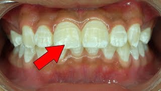 7 Ways to Get Rid Of White Spots on Teeth [upl. by Sacks]