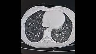 Eleven years old female child presented with expiratory stridor Tracheomalacia [upl. by Leveridge]