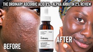 THE ORDINARY ALPHA ARBUTIN 2  HA REVIEW  BEFORE amp AFTER 6 WEEKS [upl. by Esinyl]