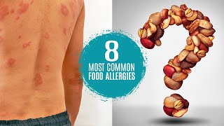 What are the 8 Most Common Food Allergies Symptoms Treatment amp Testing [upl. by Ahseer171]