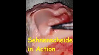 Die Sehnenscheide  Vagina synovialis tendinis in der Bewegung Anatomie in Action  LIVE [upl. by Ahsyt]