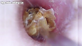 Ear Wax Removal 173 Thick and hard earwax causes ear pain and itching  Ear Cleaning ASMR [upl. by Gannie]