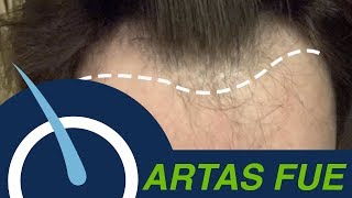 Hair Transplant to restore Receding Hairline [upl. by Asyram184]