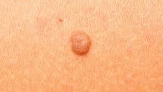 PLASMA MOLE REMOVER PEN REVIEW amp DEMO I Does it really remove freckles skin tags and moles [upl. by Barlow]