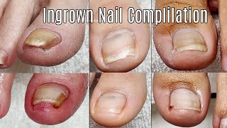 Ingrown Toenail Cleaning Compilation [upl. by Bensen632]