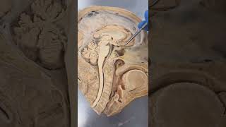 REAL Human Pituitary Gland [upl. by Anastasio972]