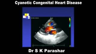 Cyanotic Congenital Heart Disease Dr S K Parashar [upl. by Ahsets523]