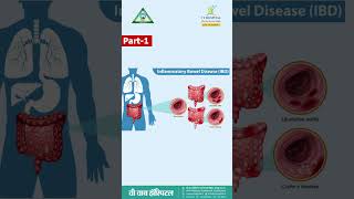 Inflammatory bowel disease IBD PART1Dr Prashant Kumar Singh Gastroenterologist VY Hospital [upl. by Noseyt]