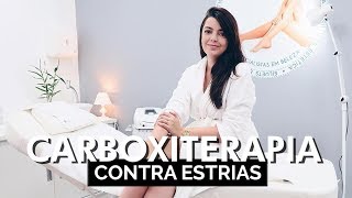 Carboxiterapia para eliminar estrias  Lia Camargo para Siluets [upl. by Leopoldeen]