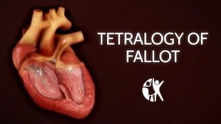 Tetralogy of Fallot  Cincinnati Childrens [upl. by Ahtibbat]