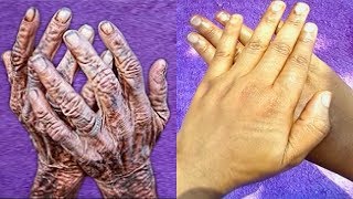 HOW I REMOVE WRINKLES ON MY HANDS amp FINGER  CLEAR HAND ROUGHNESS AND DRYNESS [upl. by Yettie]