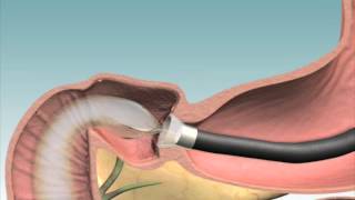 Endobarrier  Explantation [upl. by Eindys]