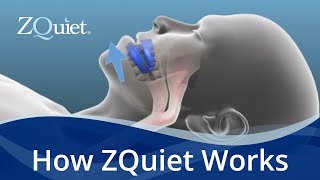 Want to Stop Snoring Learn How ZQuiet Anti Snoring Mouthpieces Work [upl. by Bonina351]