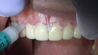 Case of the week Veneers Two Ways Obsidian® amp Solid Gold [upl. by Eadahs]