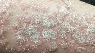 DENTAL PICK vs PSORIASIS FLAKES [upl. by Jerri788]