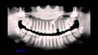 Treatment of impacted canine [upl. by Airliah]